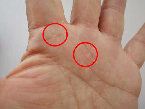 ばね指左　手術跡1.jpg